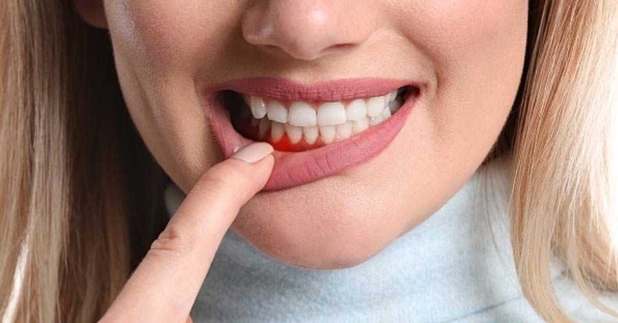 A New Way to Prevent Gum Disease Without Destroying Beneficial Bacteria