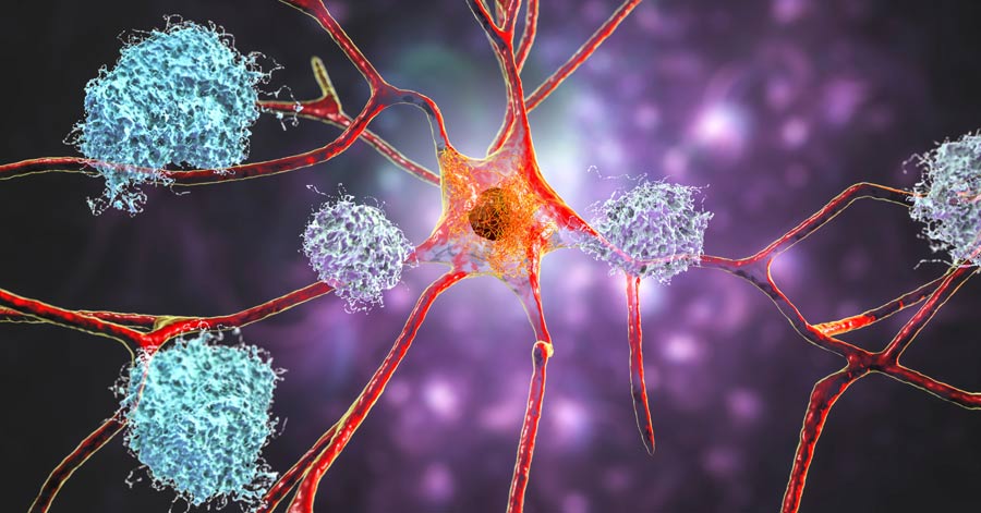 Gene Linked to Alzheimer’s Shows Common Signal Across Racial Groups