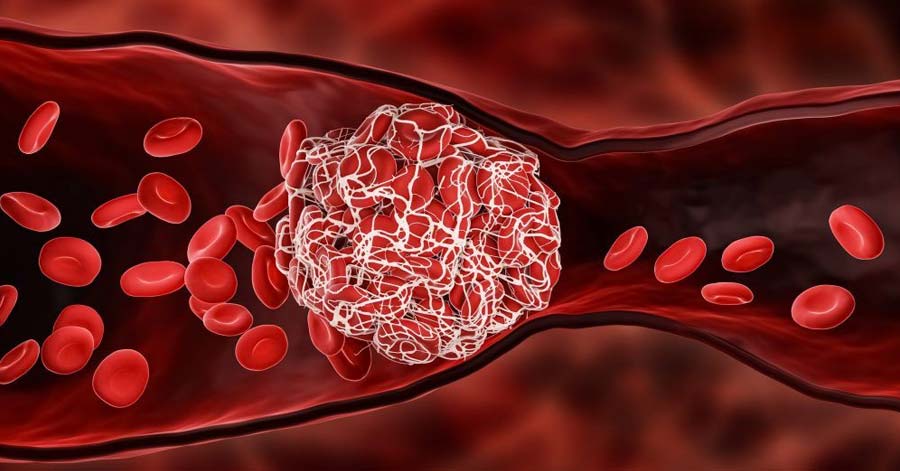 Long COVID Linked to Inflammation and Tiny Blood Clots, Researchers Find